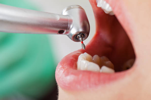 Best Emergency Wisdom Teeth Removal in Wetumpka, AL